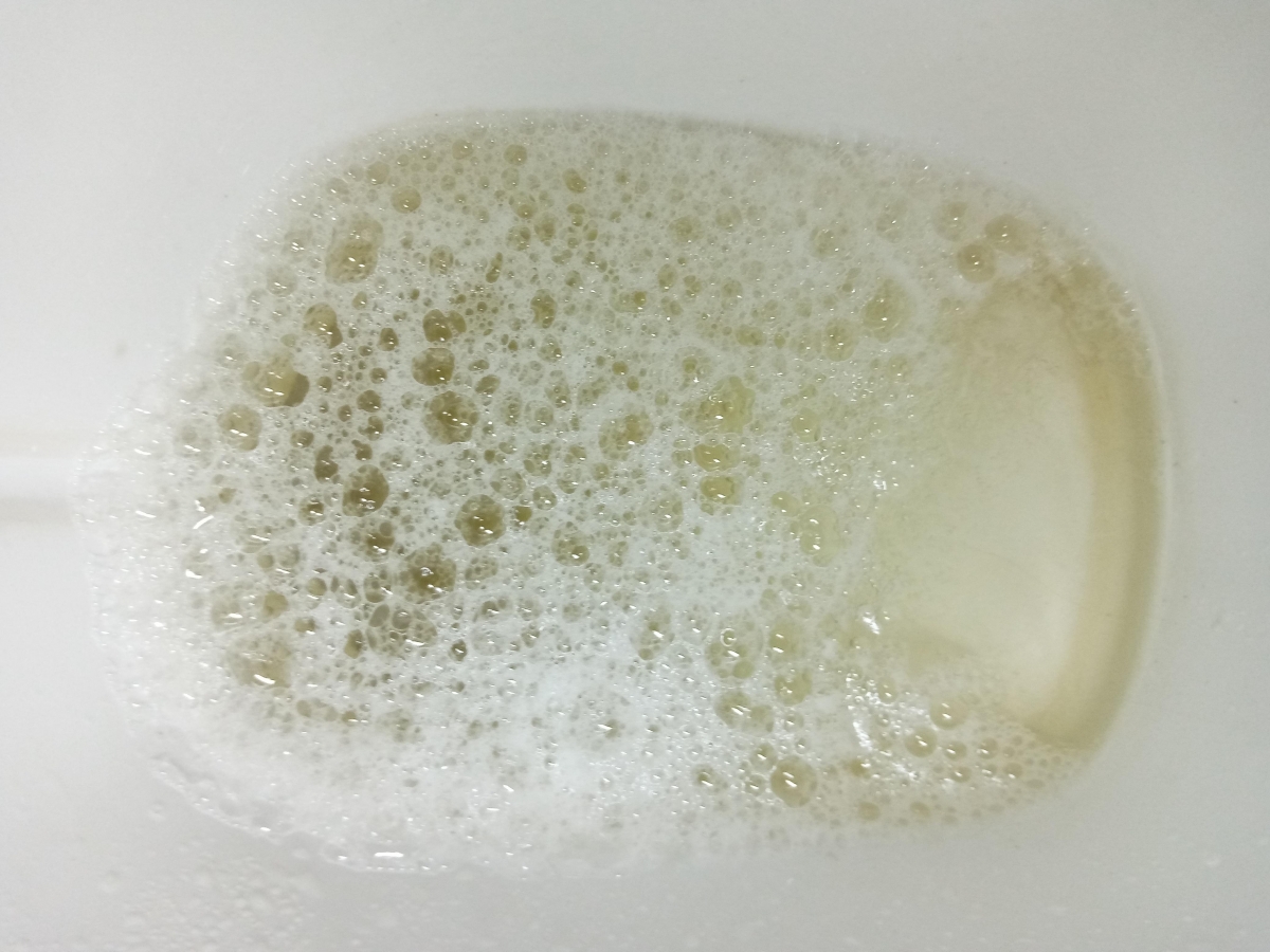 Tiểu ra bọt có phải dấu hiệu bệnh lý đáng lo lắng?