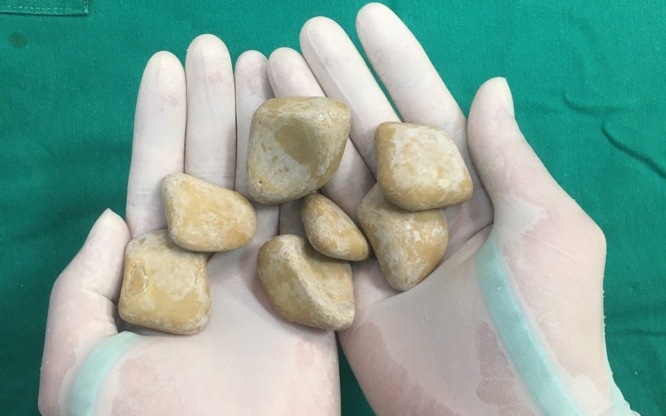 Sỏi bàng quang - kẻ thù tiềm ẩn làm rối loạn "chuyện yêu"