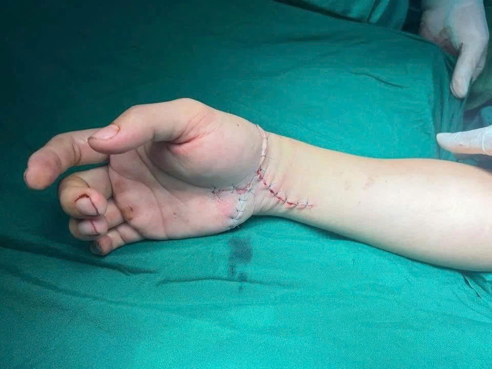 Cứu đôi tay Tiktoker ở Thái Nguyên qua lời kể của bác sĩ