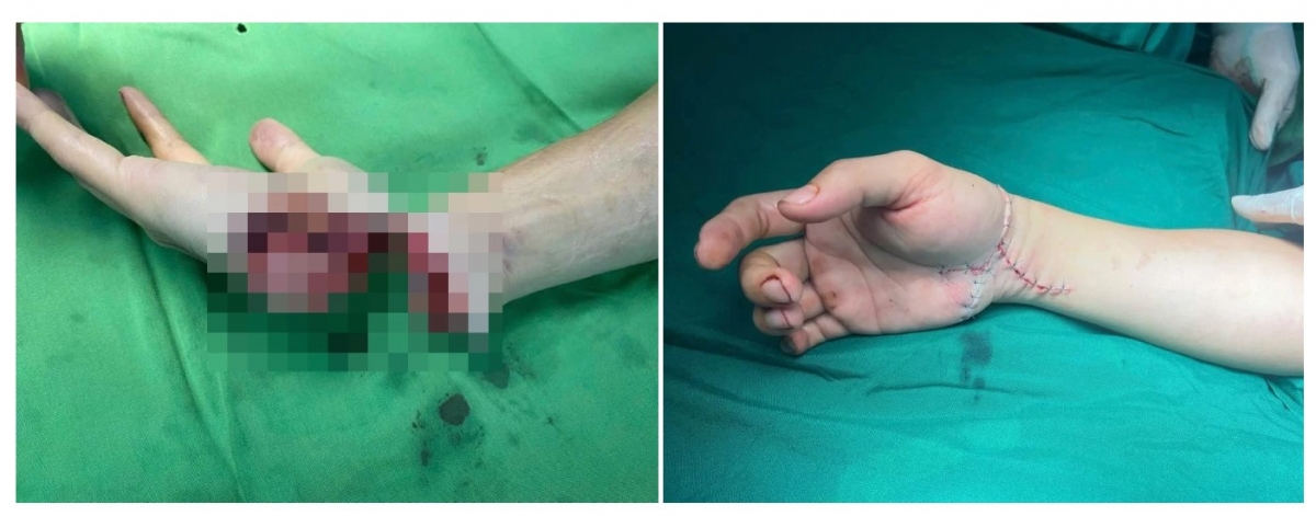 cứu đôi tay tiktoker ở thái nguyên qua lời kể của bác sĩ hình ảnh 1 cuu doi tay tiktoker o thai nguyen qua loi ke cua bac si hinh anh 1