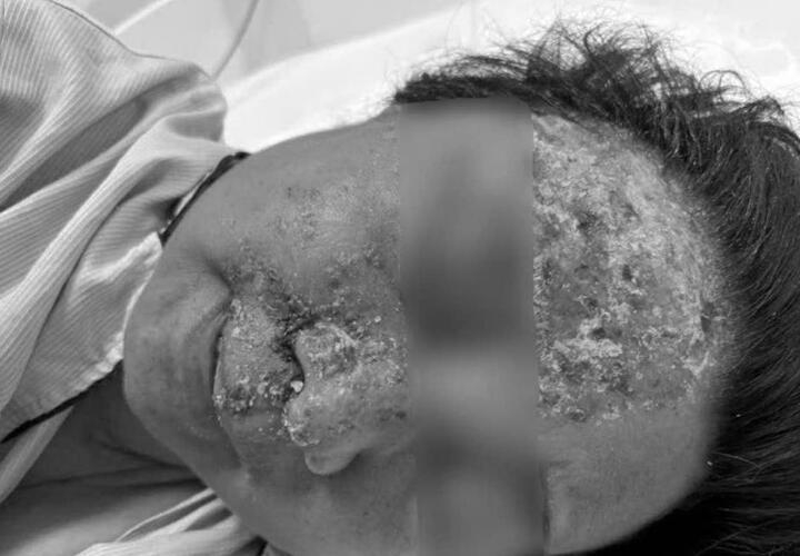 noi mun nuoc tuong di ung da, khong ngo nhiem virus gay bien chung nguy hiem hinh anh 1