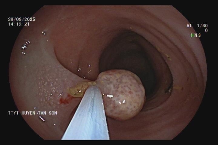 hiem gap benh nhi 9 tuoi phat hien 4 polyp truc trang hinh anh 1