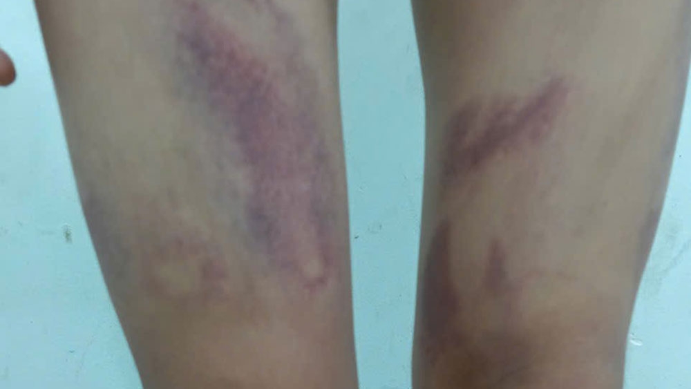 M.T bị đánh đa chấn thương. M.T bị đánh đa chấn thương.