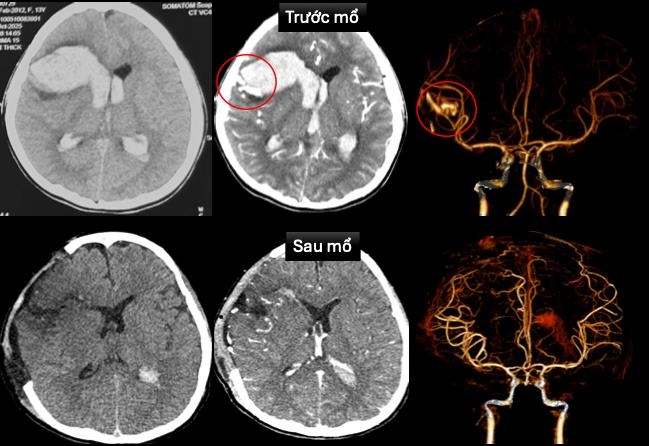 Cứu bệnh nhi bị dị dạng mạch máu não kèm bệnh cơ tim xốp hiếm gặp