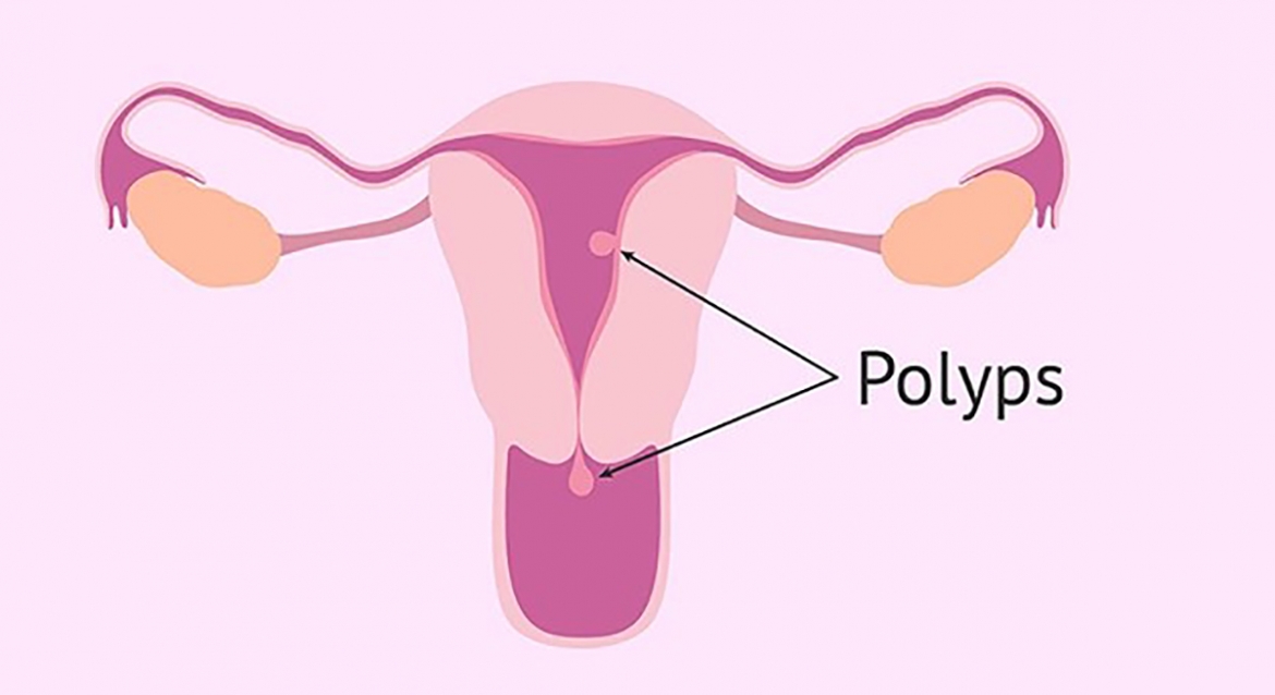 tu ca mat mau nghiem trong vi polyp buong tu cung, bac si canh bao toi ban gai tre hinh anh 1