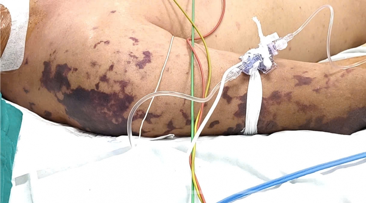 An thit lon o dam co, nguoi dan ong nguy kich vi nhiem nao mo cau hinh anh 1