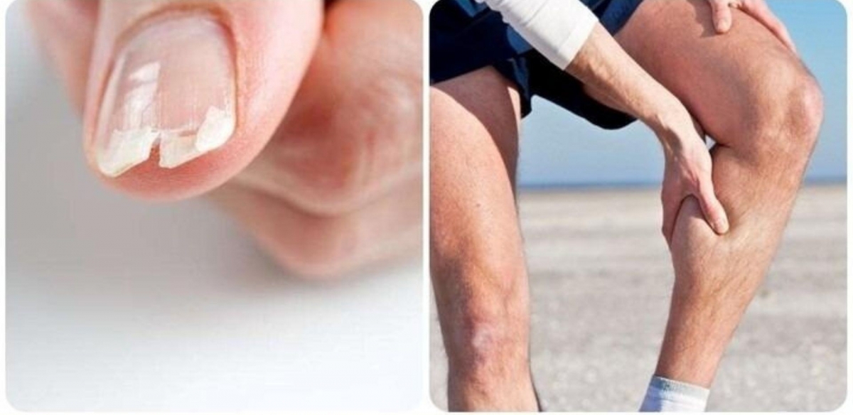 dau hieu canh bao co the dang thieu canxi hay bi nhieu nguoi bo qua hinh anh 1