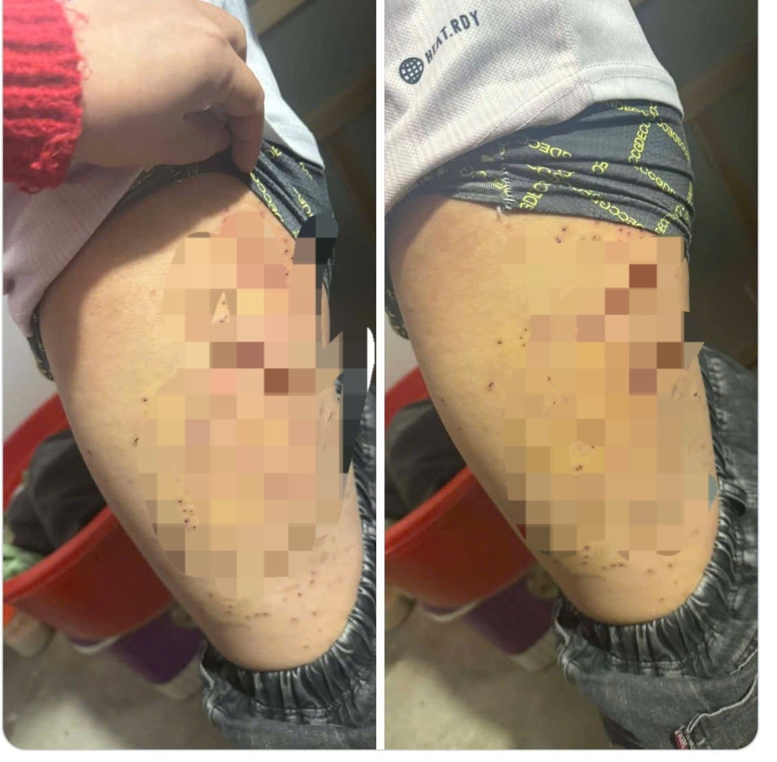 nu sinh lop 7 bi ban dung but bi dam chi chit vao dui hinh anh 1