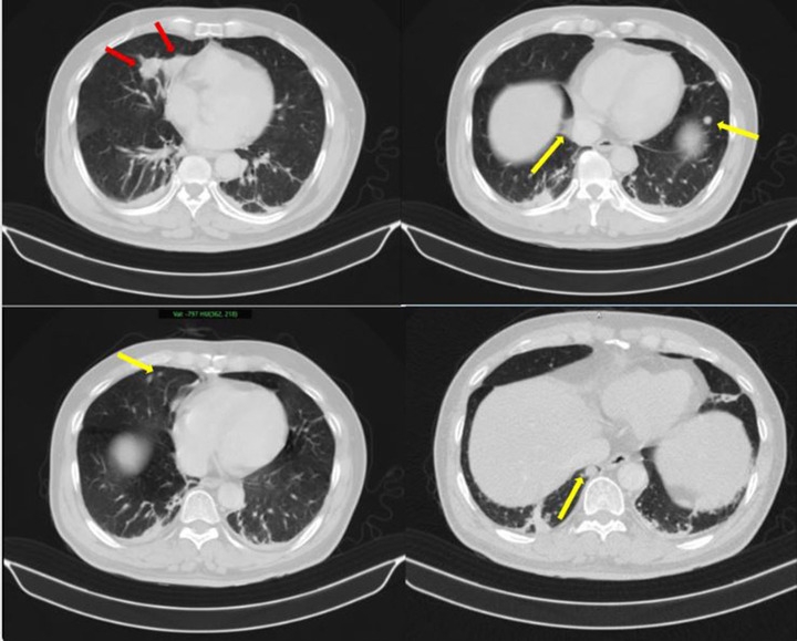 nguoi dan ong phat hien mac hai benh ung thu cung luc hinh anh 1
