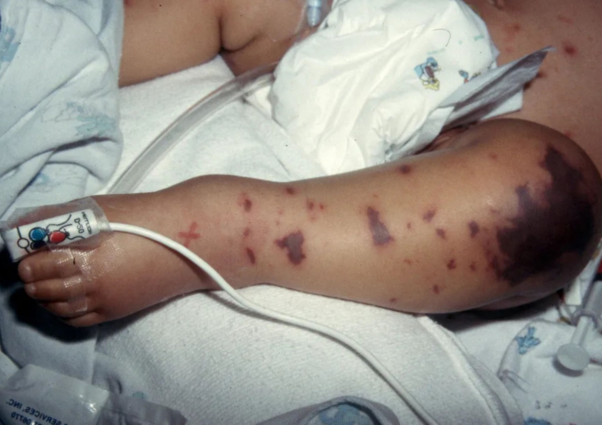 lien tuc ghi nhan cac ca mac va nguy kich do nao mo cau, nhieu nguoi tiep xuc gan hinh anh 1