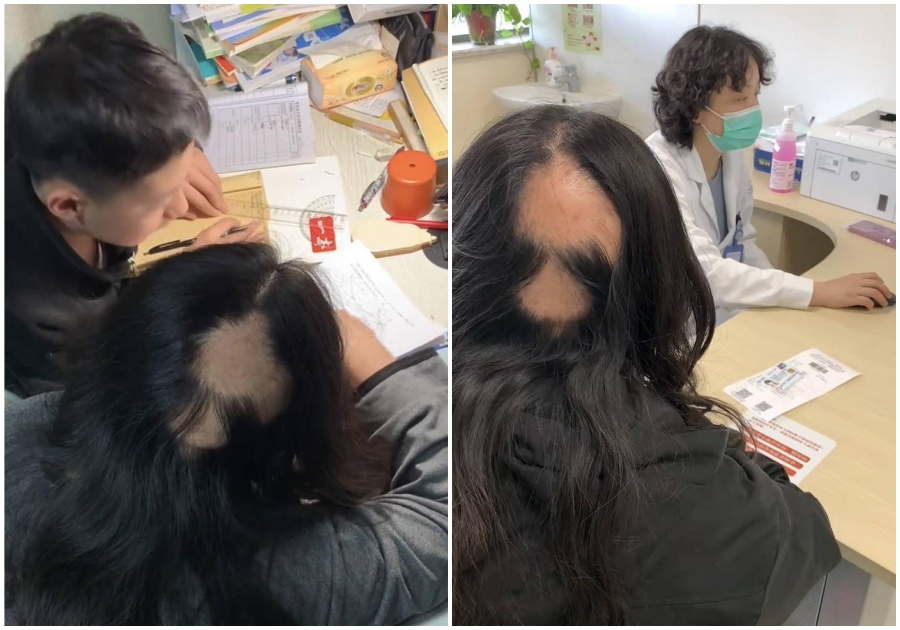 Hi hữu mẹ rụng tóc từng mảng vì áp lực thức khuya dạy con học