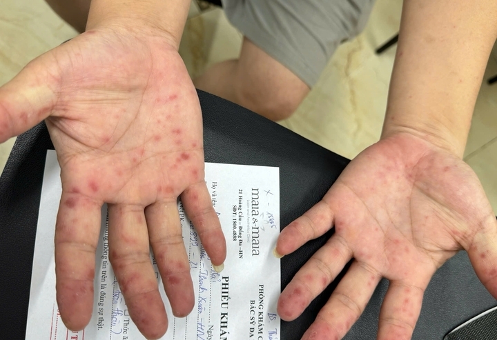 so ca tay chan mieng tang manh, canh bao nguon lay tu tay nam cua, do choi hinh anh 1