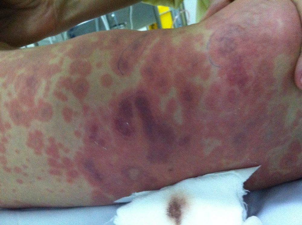 viem mang nao mo cau dien tien xau nhanh, nguy co tu vong trong 24 gio hinh anh 1