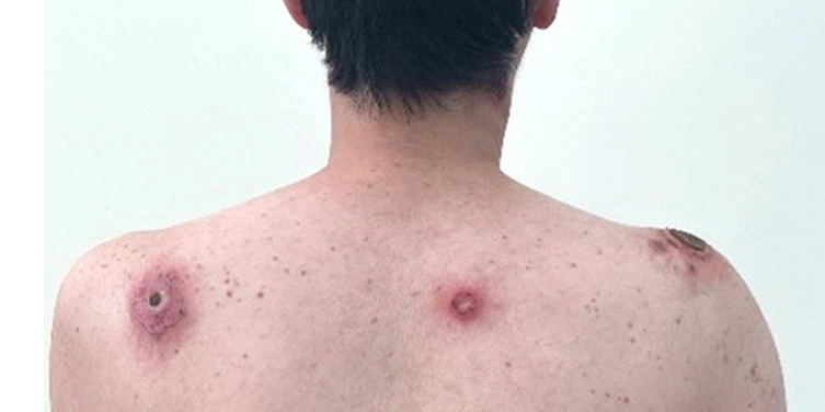 giang mai - nguy co nhiem benh tu quan he tinh duc khong an toan hinh anh 1