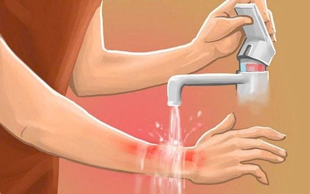 bi bong nuoc soi phai lam gi huong dan xu tri va phong tranh hinh anh 1