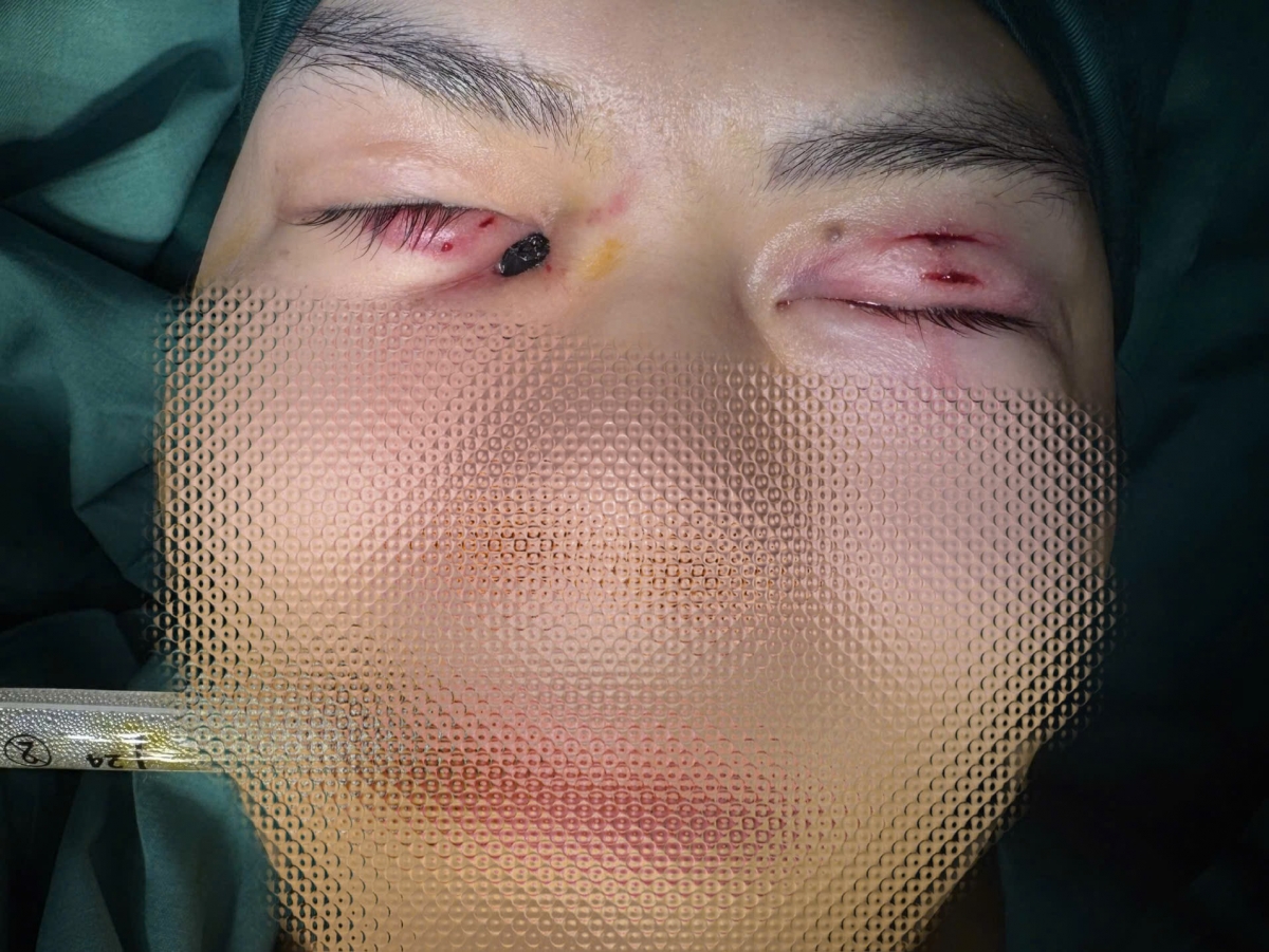 phau thuat rut 2 chiec dua dam xuyen mat nam thanh nien hinh anh 1