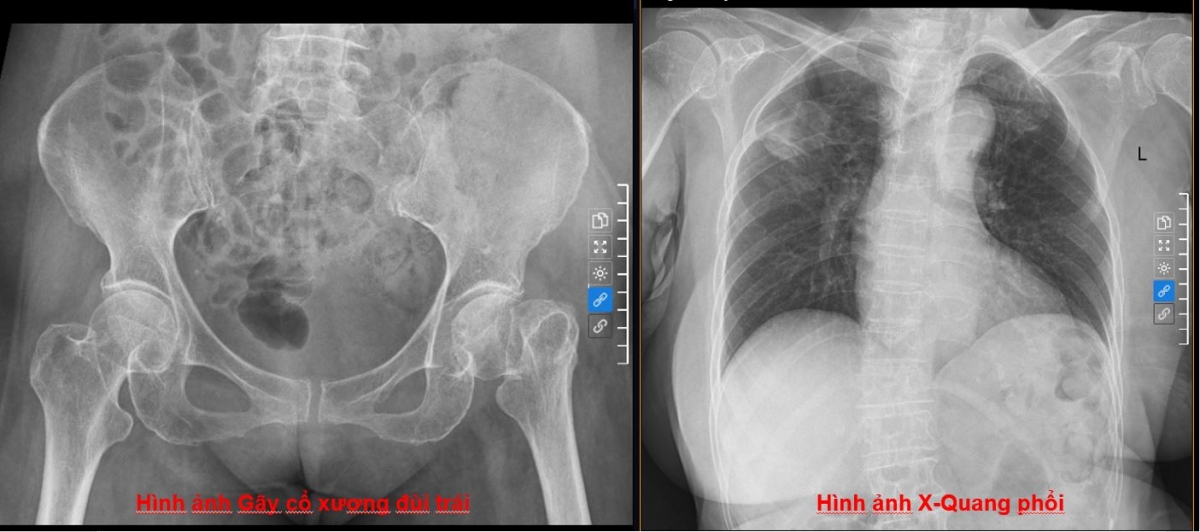 ty le tu vong toi 30 sau gay co xuong dui o nguoi cao tuoi hinh anh 1