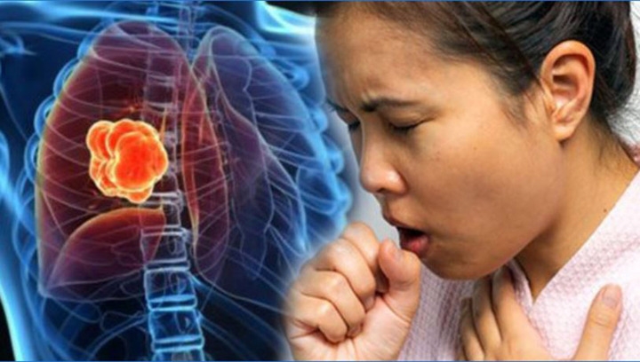 2 dau hieu khi ho canh bao ung thu phoi de bi bo qua hinh anh 1
