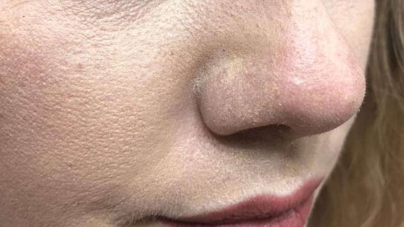 thoa kem chong nang bi moc trang nguyen nhan va cach xu ly nhanh hinh anh 1