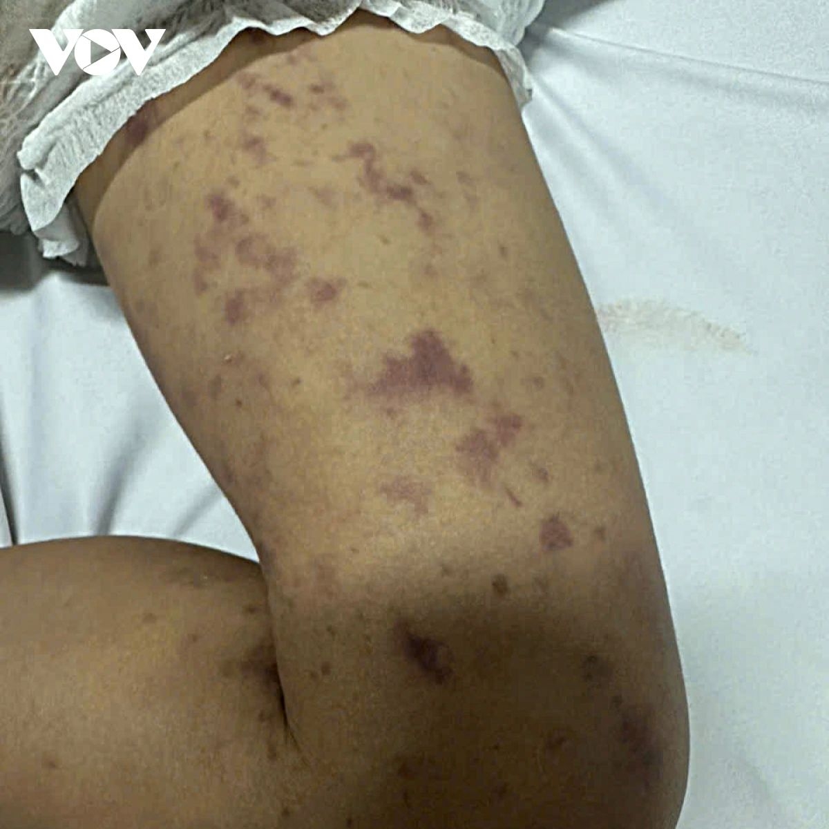 dak lak steps up meningococcal disease response after fatal case picture 2