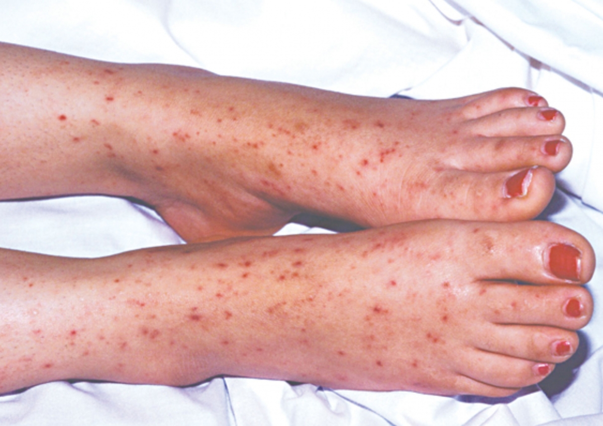 4 ca tu vong, 24 truong hop mac nao mo cau, bo y te canh bao dich hinh anh 1