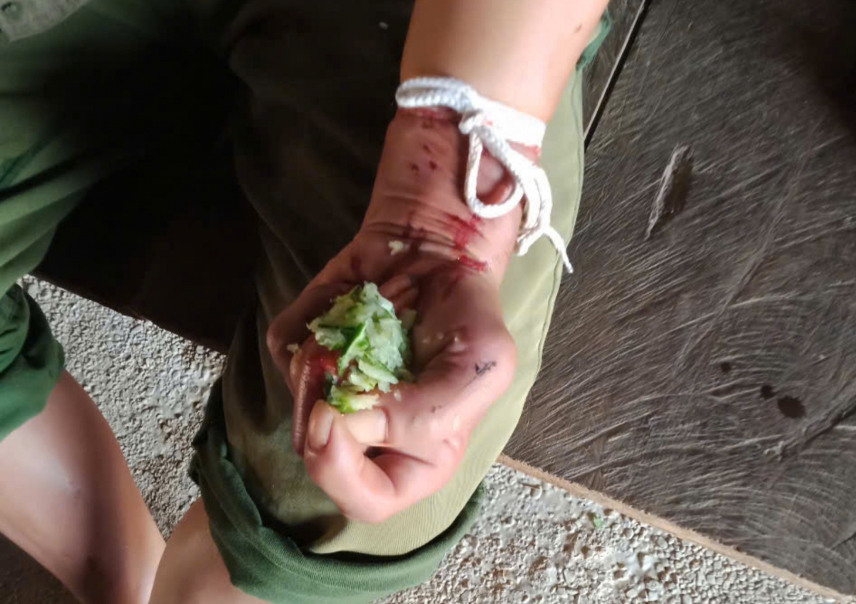 cuu song benh nhan bi ran ho mang can hinh anh 1