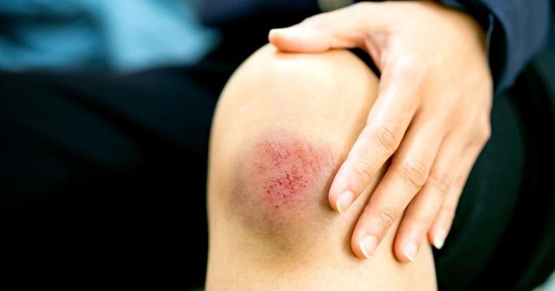 bi tray xuoc da nen an gi de vet thuong nhanh lanh, han che seo hinh anh 1