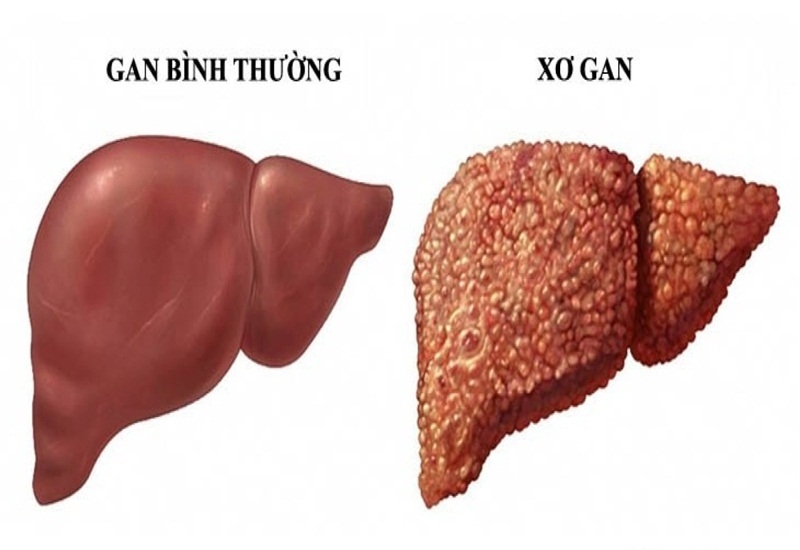 phat hien mac viem gan b man tinh va xo hoa gan khi kiem tra suc khoe dinh ky hinh anh 2