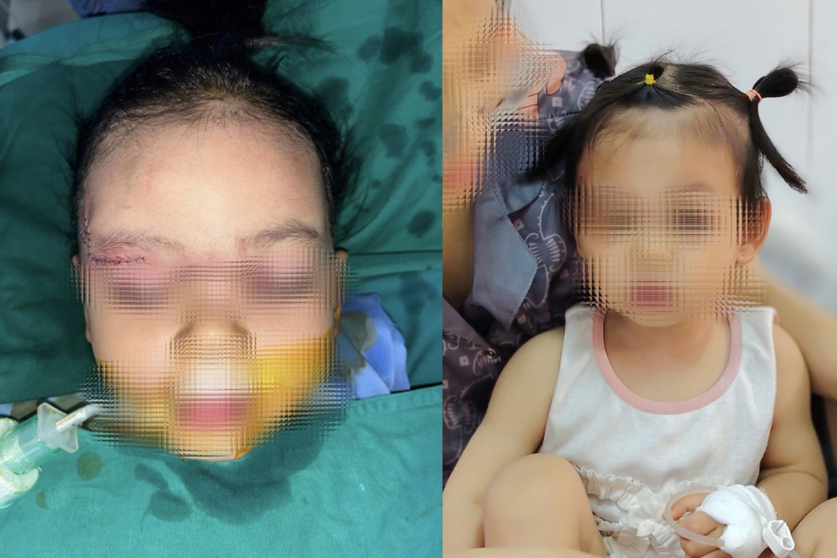 Bé gái 22 tháng tuổi bị chó cắn tổn thương nghiêm trọng khuôn mặt