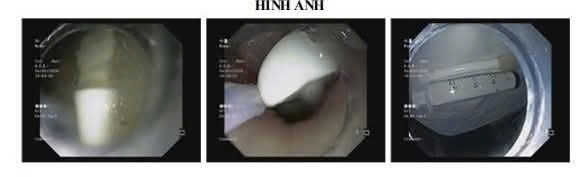 suyt thung da day vi su co nuot ban chai danh rang khi ve sinh luoi hinh anh 1