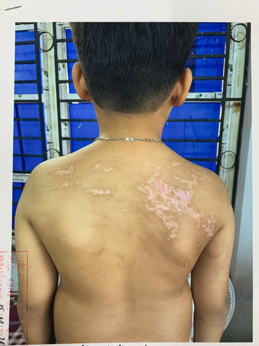 phu tho khoi to nguoi cha danh con ruot hon 7 tuoi thuong tich 36 hinh anh 2