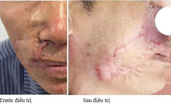 nhung ai co nguy co bi ung thu bieu mo te bao day hinh anh 1