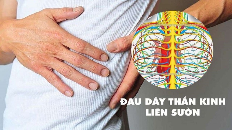 Dung chu quan voi dau day than kinh lien suon khi nao can di kham ngay hinh anh 1