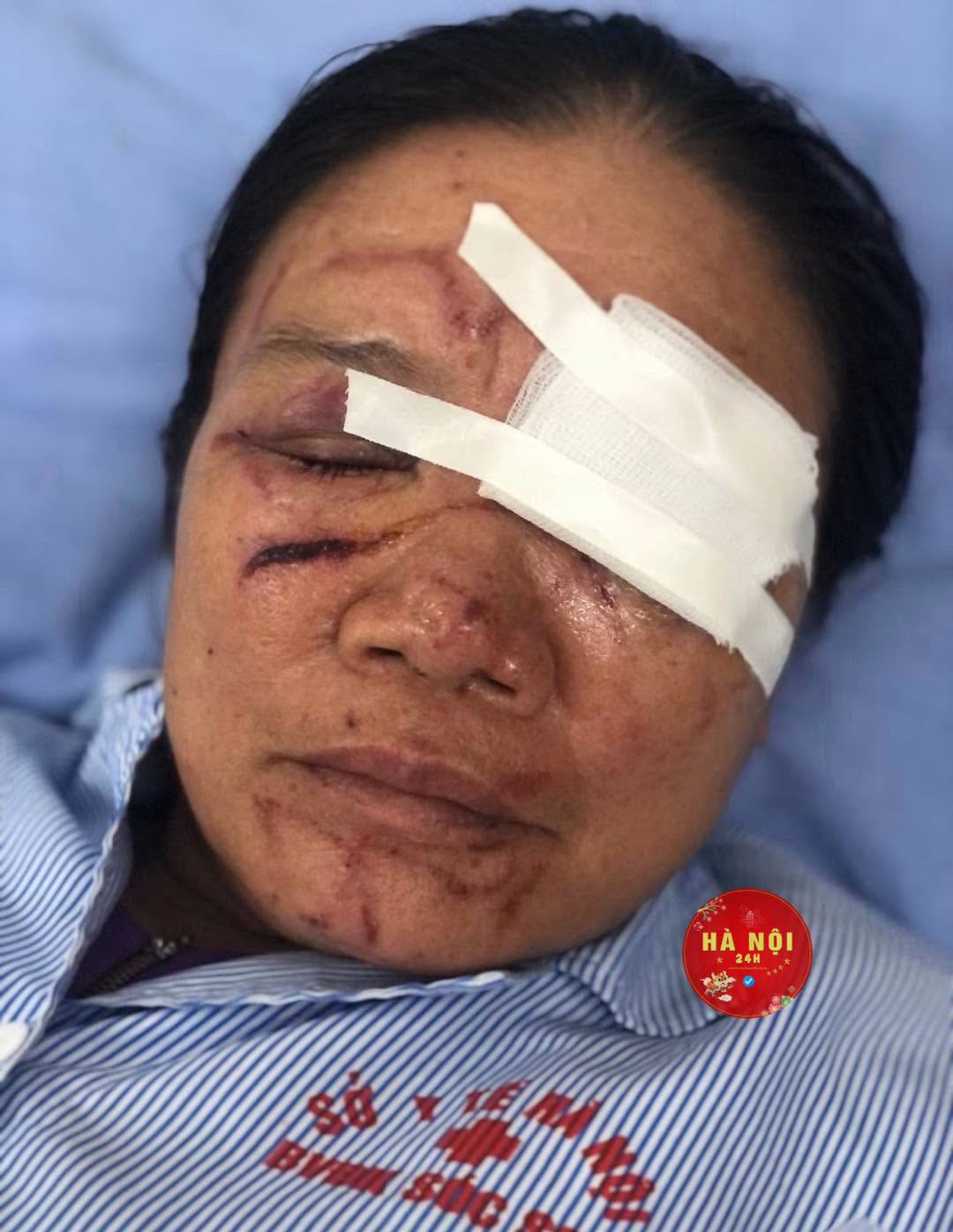 vu tieu thuong bi xit nuoc chay mau mat co quan chuc nang phu tho vao cuoc hinh anh 2
