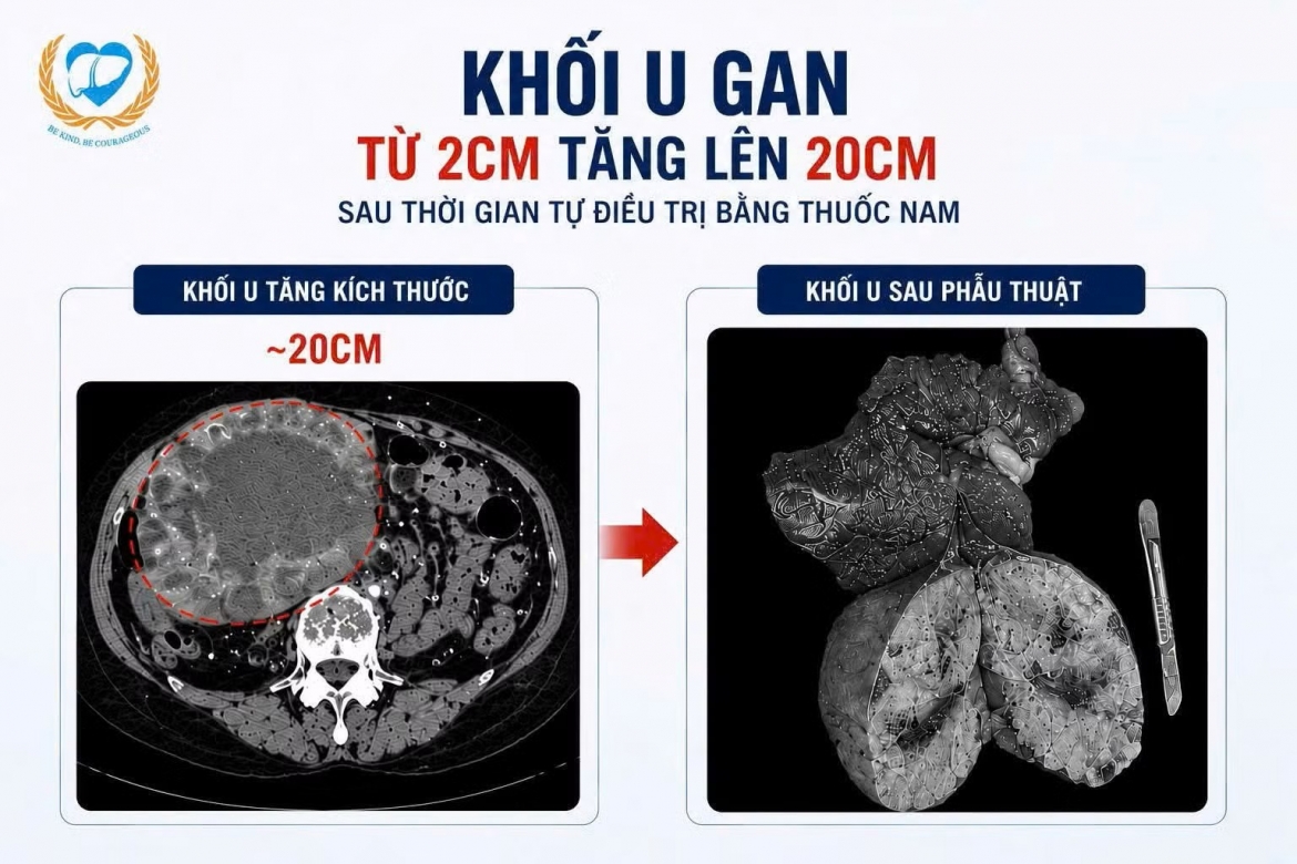tu dieu tri u gan tai nha, khoi u phinh gap 10 lan hinh anh 1