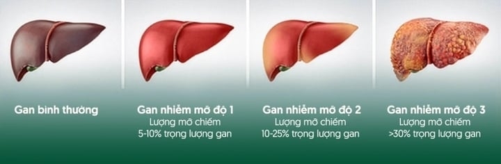 pgs nguyen lan hieu khuyen dung voi uong thuoc bo gan khi moi phat hien nhiem mo hinh anh 1