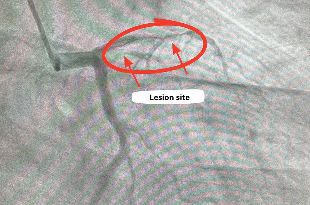 hungarian tourist saved from acute myocardial infarction after timely intervention picture 1