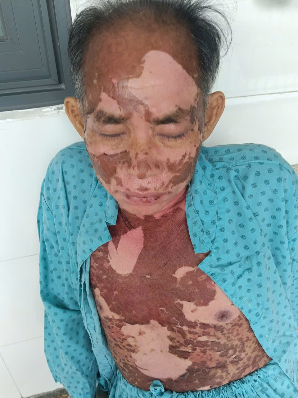 Tự dùng thuốc nhỏ mắt, người đàn ông bị hoại tử da nghiêm trọng