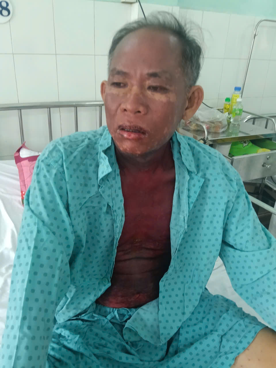 tu dung thuoc nho mat, nguoi dan ong bi hoai tu da nghiem trong hinh anh 1