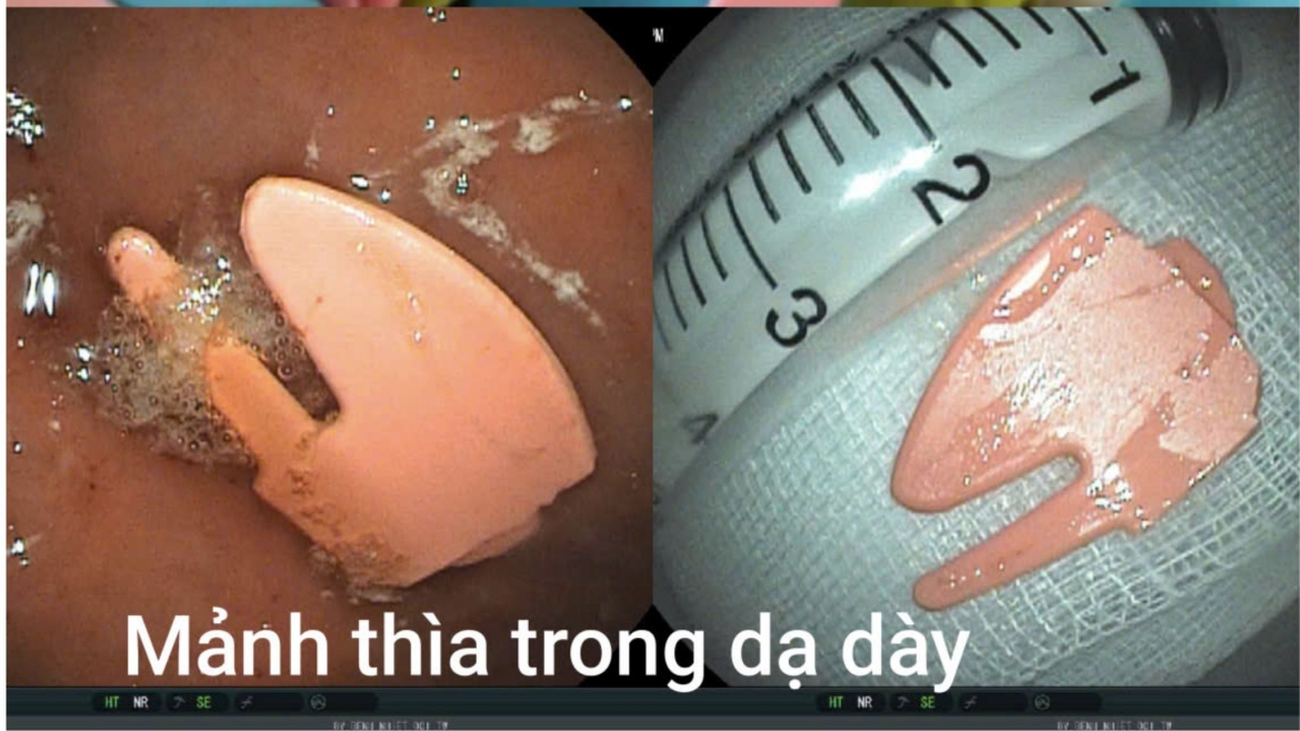 tu xuc an sua chua, be 20 thang tuoi nuot manh thia nhua gay vao da day hinh anh 2