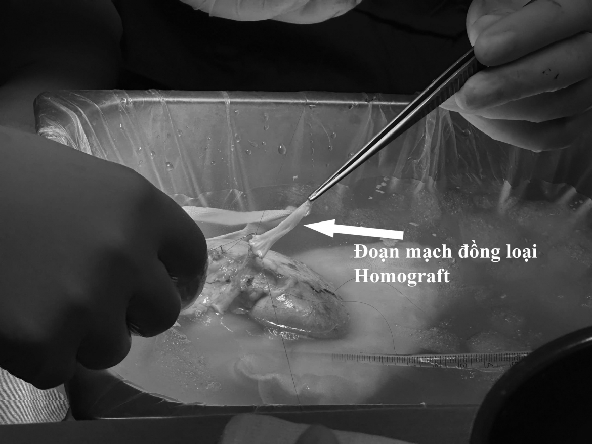 ca ghep than thu 8 dac biet tai benh vien viet nam-thuy Dien uong bi da xuat vien hinh anh 3