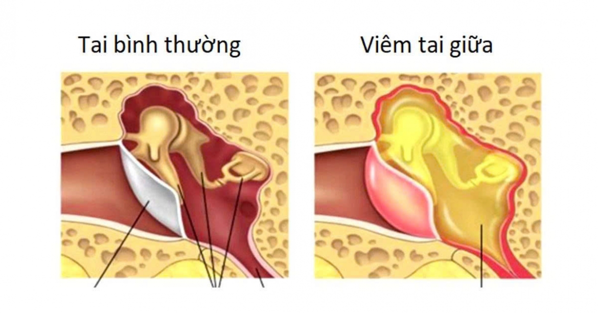 Dau tai, u tai cho chu quan nhan biet 3 dang viem tai thuong gap hinh anh 1