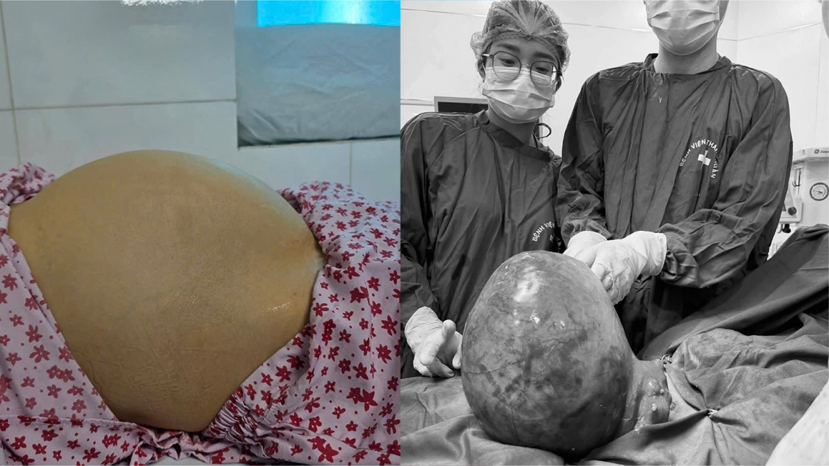 Bụng to bất thường, người phụ nữ Hà Nội bất ngờ với khối u xơ tử cung 6kg