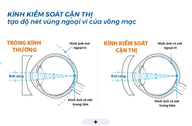 Deo kinh dung do nhung van tang do bai toan kiem soat can thi o tre hinh anh 2