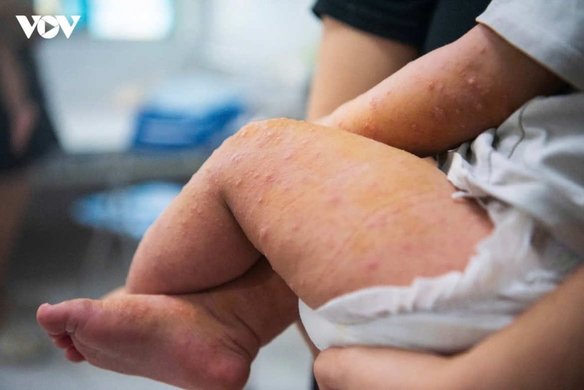 inside pediatric wards amid daily influx of flu and hfmd cases picture 6