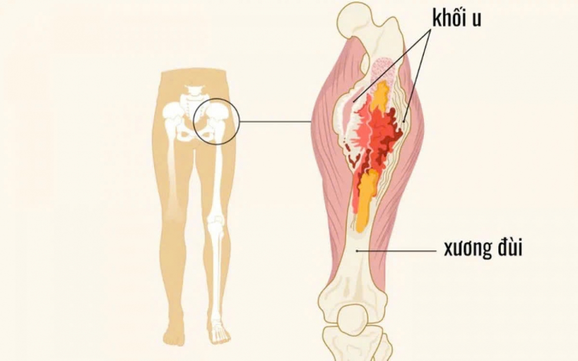 ung thu xuong o tre khong con dong nghia voi cat cut chi hinh anh 1