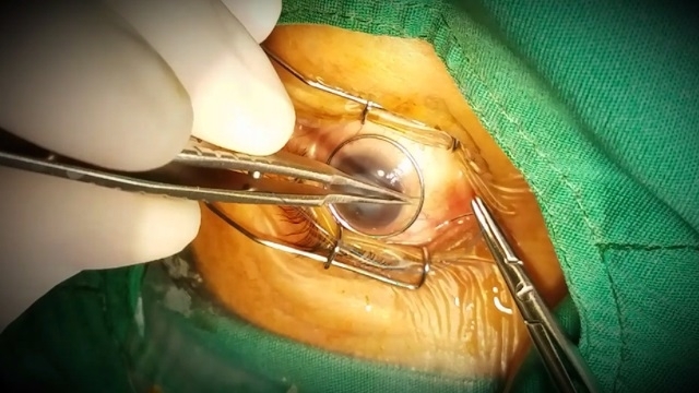 First “two-in-one” combined corneal transplant carried out in southern region