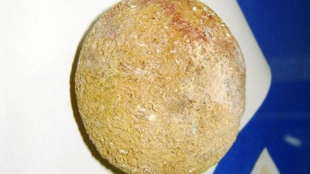 Kidney stone as big as orange removed from poor man