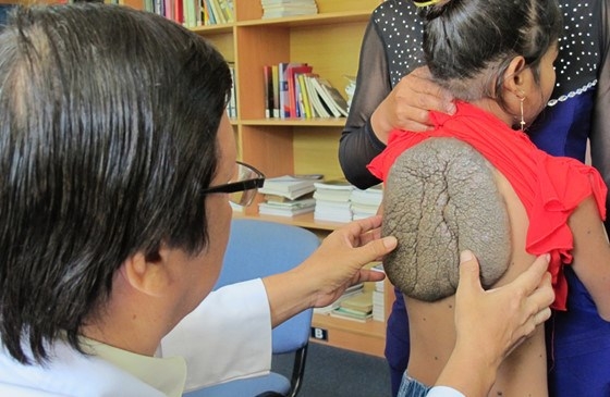 Vietnamese doctors successfully remove ‘turtle shell’ on 10-year-old girl’s back