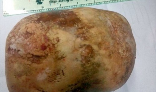 Huge stone removed from Vietnamese man’s bladder